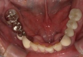 【骨が少なくても諦めない】ソケ